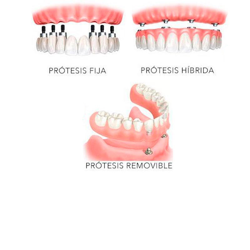 tipos de protesis sobre implantes