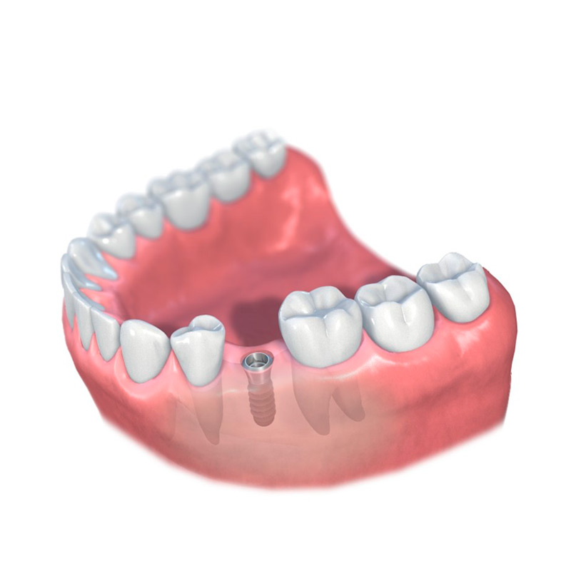 implantes dentales Straumann Dental Implant System