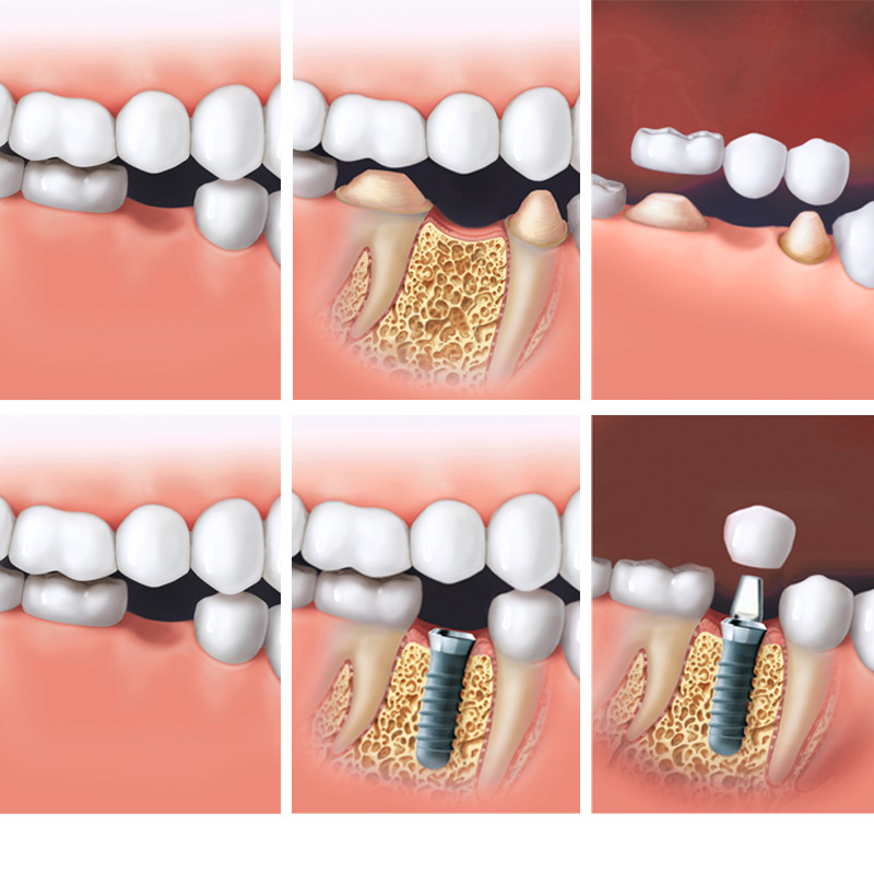 sistema implantes dentales de dentales