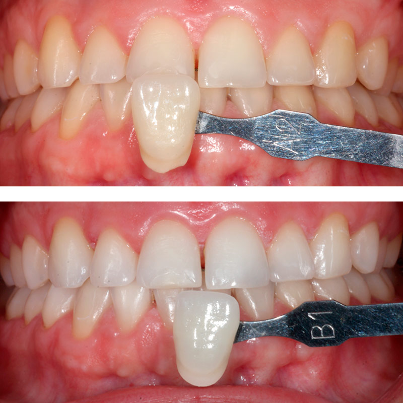 antes y despues del blanqueamiento dental