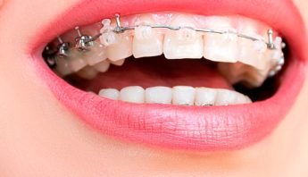 brackets para ortodoncia