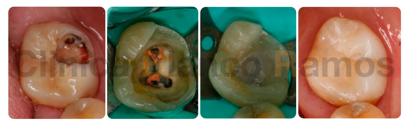 Tratamiento incrustación dental