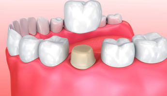 INCRUSTACIONES DENTALES Y CORONAS