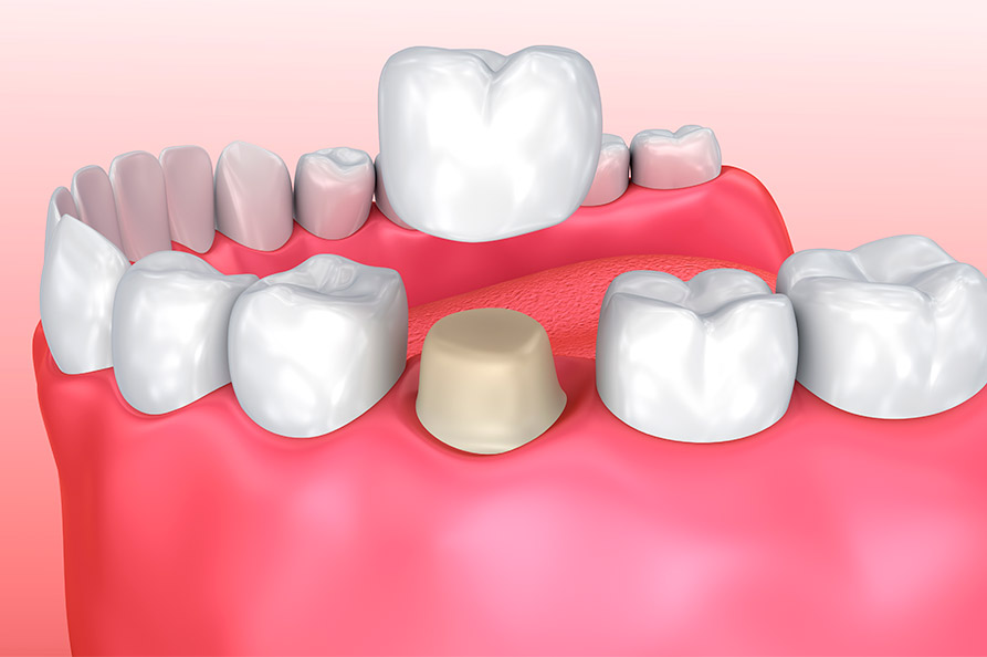 INCRUSTACIONES DENTALES Y CORONAS