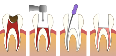 Cómo se hace una endodoncia